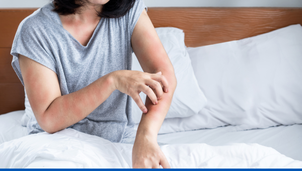 Piqûre punaise de lit : tout savoir